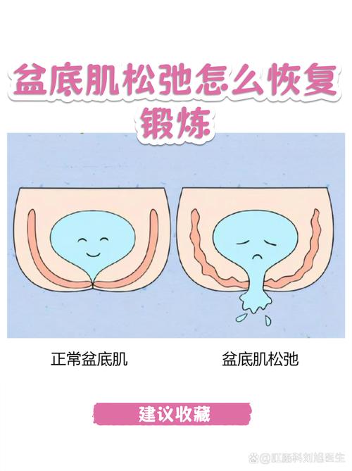 盆底肌训练前后对比:这类视频的问题在哪
