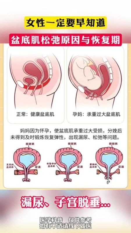 骨盆底和盆底肌是同一个意思吗？3 个名词分清-男性盆底肌训练社区_凯格尔运动与PC肌怎么练 - P动