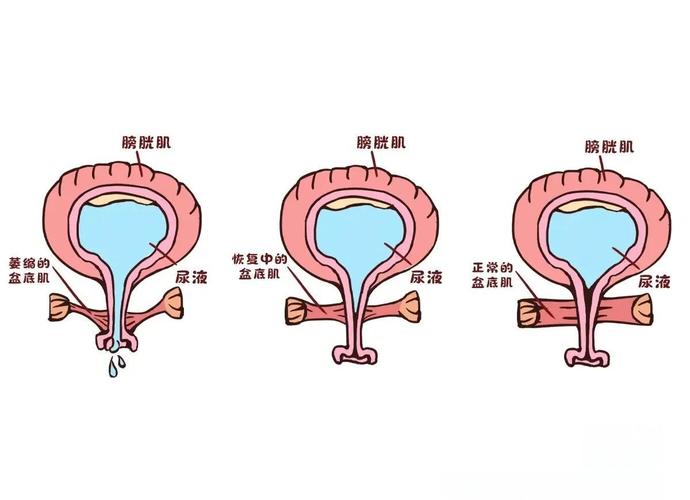 排尿时盆底肌:为什么「松得开」比「收得紧」难