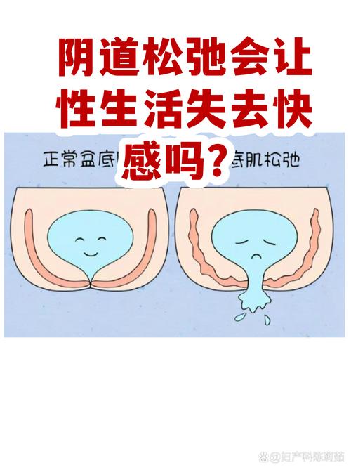 步数与盆底肌:走得越多的人,反而越该练